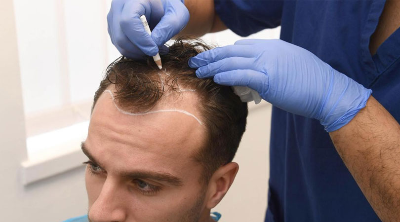 Hair Transplant, 2023 Hair Transplant Cost in Turkey