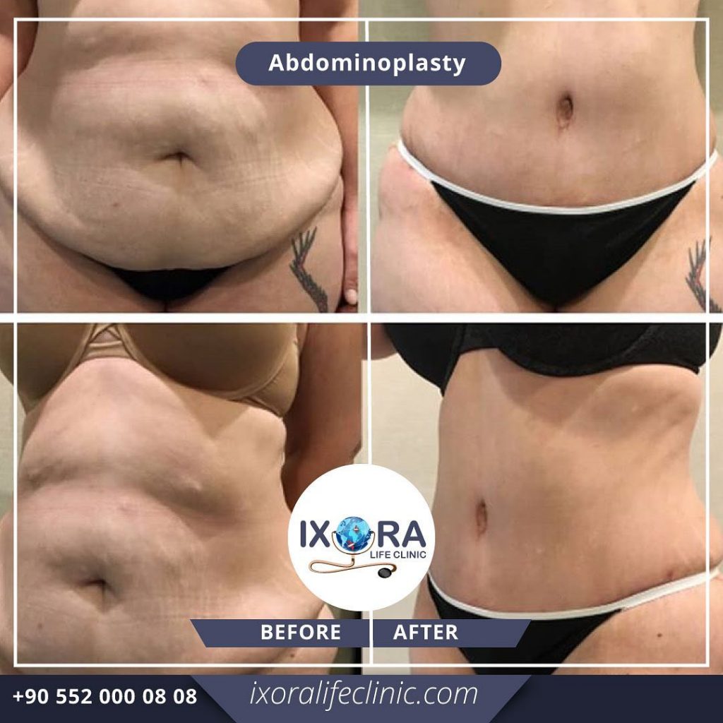 Do You Need a Full or Mini Tummy Tuck? - Amirlak Plastic Surgery