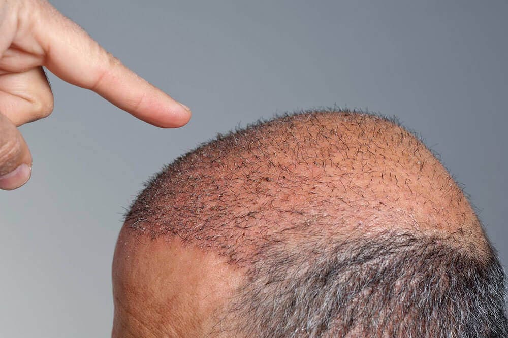 Folliculitis After Hair Transplant Causes Symptoms Treatments  Wimpole  Clinic