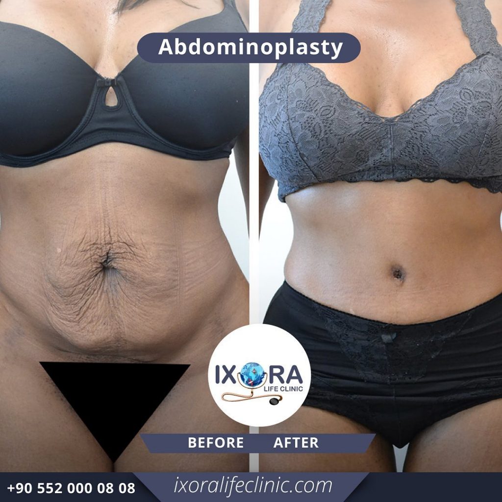 Abdominoplastía (Cirugía Estética del Abdomen) - Kelamis Plastic