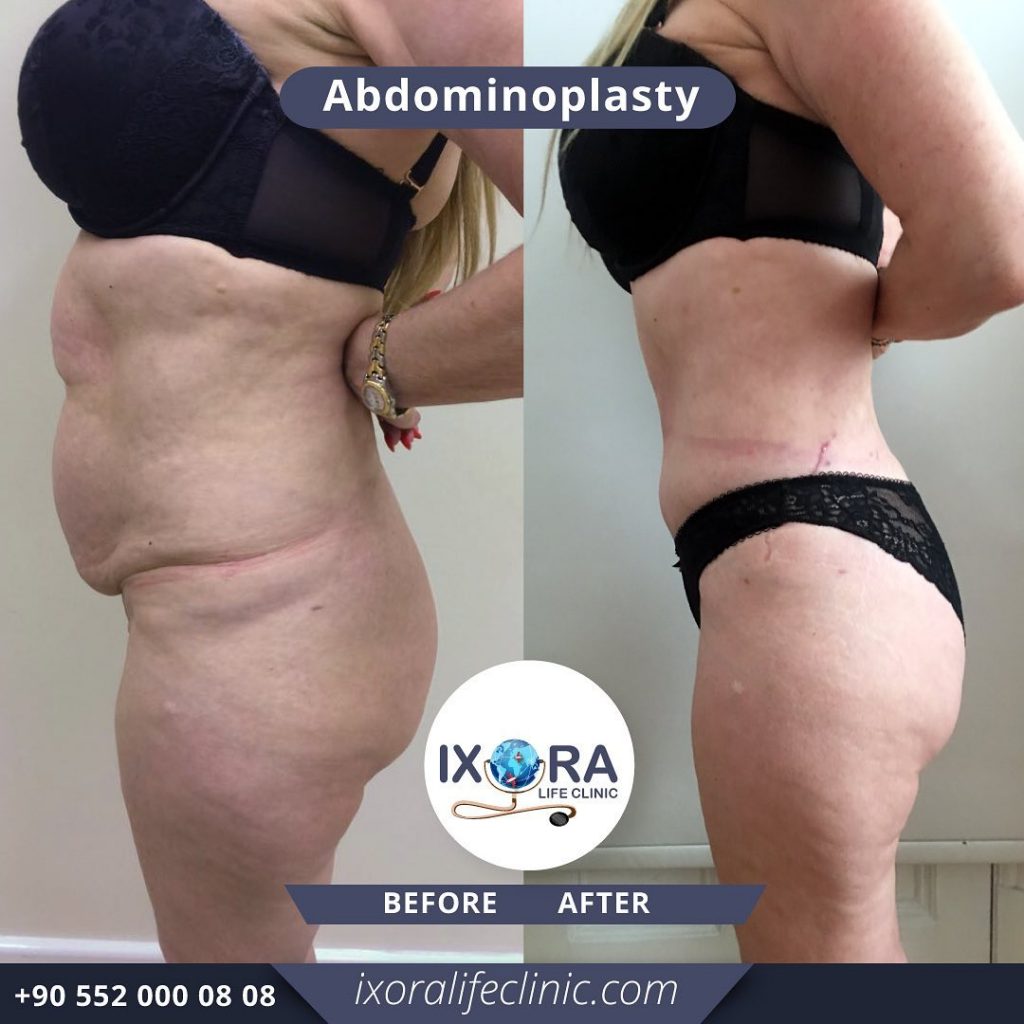 Quelle gaine pour ma liposuccion ou abdominoplastie ? - Clinique equilibre  abdominoplastie